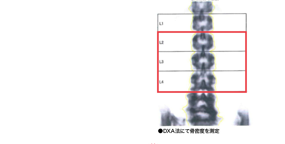 DXA法にて骨密度を測定